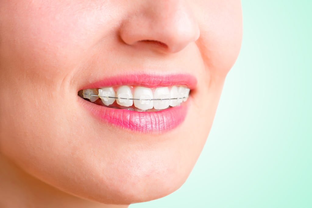 Gold Coast Braces and Orthodontics SmileCentre